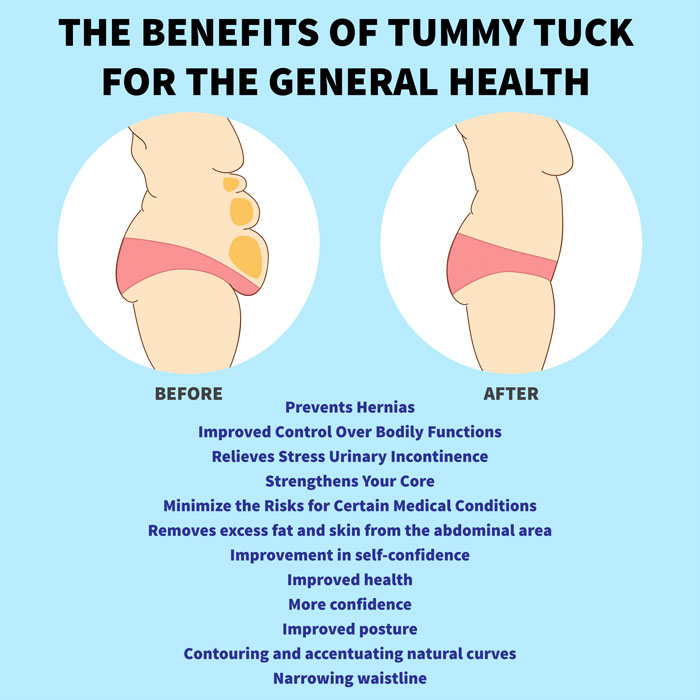 Tummy tuck benefits