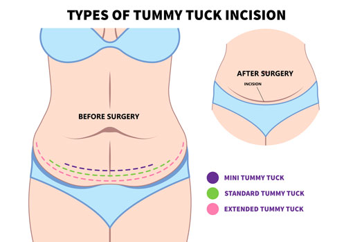 Types of Tummy Tuck Incision